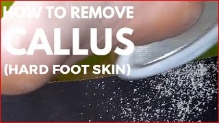 How to remove callus Hard foot skin [upl. by Retsel]