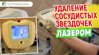 УДАЛЕНИЕ СОСУДИСТЫХ ЗВЕЗДОЧЕК НА НОГАХ ЛАЗЕРОМ 🧚‍♂️🙌🏻 Exotherme Сосудистая сетка на ногах [upl. by Oreves]