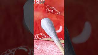 ASMR Zombie oral treatmentoral stones stomatitis tonsillitis treatment animation asmr좀비 압안결석치료 [upl. by Nerra357]