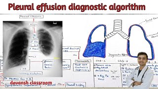 pleural effusion  approach  diagnostic algorithm  in Hindi [upl. by Eekram]