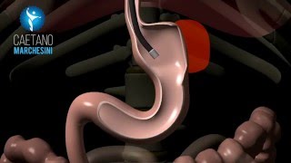 Sleeve Gastrectomy Chronic Leak Endoscopic Treatment [upl. by Darcy651]