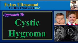 Fetus Ultrasound Cystic Hygroma [upl. by Aeet]