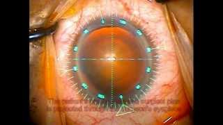 The Verion Image Guided System in Cataract Surgery [upl. by Odoric]