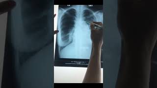 Chest XrayPneumothorax ē Cardiomegaly [upl. by Brittani]