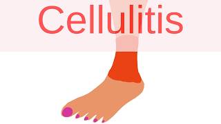 What is Cellulitis  Pathology mini tutorials [upl. by Campney782]