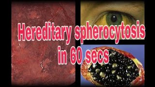 Hereditary Spherocytosis  A 60 sec Pathology lecture [upl. by Airahs]