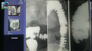 Radiology cases Esophagography Gastrography Barium enema Irrigography online x ray library part 53 [upl. by Aidin550]