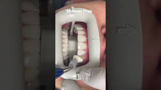 Minimally Invasive Porcelain Veneers❤️ [upl. by Notle127]