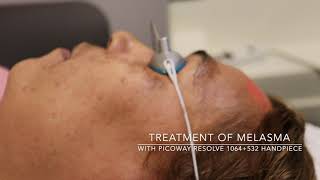 Treatment of melasma with the Picoway Resolve 1064532 nm hand piece [upl. by Renat592]