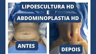 MINHA CIRURGÍA PLÁSTICA Abdominoplastia HDLipoescultura HD e Enxertia no bumbum mostrei tudo😱 [upl. by Westfahl444]