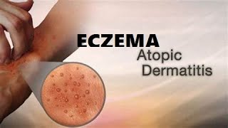 What is Eczema A Type of skin condition I Atopic Dermatitis I Allergic eczema I Neurodermatitis [upl. by Cirillo]