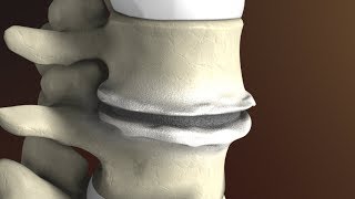 Degenerative Disc Disease Spondylosis explained by Spine Surgeon Dr Jessica Shellock Plano TX [upl. by Shewchuk11]