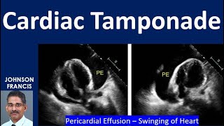 Cardiac Tamponade [upl. by Durrell134]