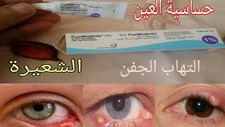 مرهم للعين 👍علاج التهاب العين والتعفنات والشعيرة👀 [upl. by Gilli696]