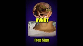 Frog Sign AVNRT [upl. by Gladys236]