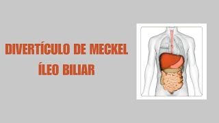 DIVERTÍCULO DE MECKEL  ÍLEO BILIAR  2024  II  USMP [upl. by Cid]