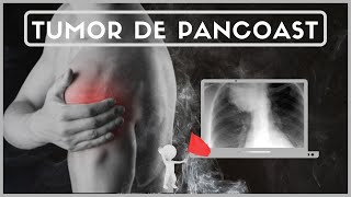 TUMOR DE PANCOAST Y DOLOR DE HOMBRO Signos y síntomas [upl. by Erhard]