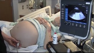 Ultrasound for Paracentesis  BAVLS [upl. by Moffitt]