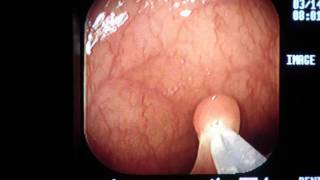 Removal of Small Colon Polyp During Colonoscopy  Los Angeles Colonoscopy [upl. by Dnomder]