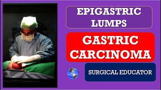 GASTRIC CARCINOMA How to DIAGNOSE amp TREAT EPIGASTRIC LUMPS Abdominal Lumps [upl. by Ainadi]