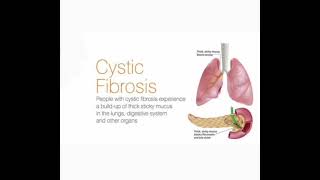 Cystic fibrosis History Part 1 mrcpch Clinical [upl. by Rehpoitsirhc]