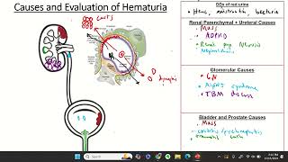 Approach to Hematuria [upl. by Eilssel]