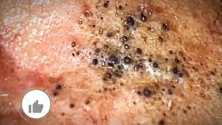 Most Satisfying CloseUp Blackhead Removal 2024 [upl. by Bauske]