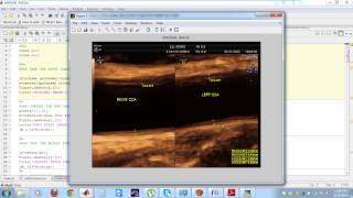 SD IEEE MATLAB ROBUST CAROTID ARTERY RECOGNITION IN LONGITUDINAL BMODE ULTRASOUND IMAGES [upl. by Fredric]