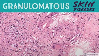 Granulomatous Skin Diseases 101 Dermpath Basics for Dermatology Pathology amp USMLE [upl. by Siraj441]