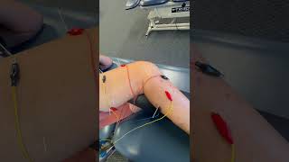 Knee Surgery Get Back on Your Feet FASTER with Dry Needling [upl. by Ymiaj430]