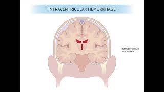 Intraventricular Haemorrhage mrcpch Recall Communication [upl. by Joelie909]