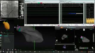 Navigation with Robotics for Arrhythmias Originating from the AMC [upl. by Ahsienal]