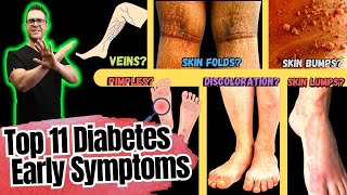 11 Early Type 2 Diabetes Symptoms in Your Feet [upl. by Taddeo335]