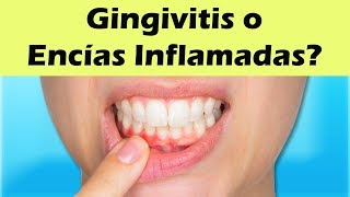 COMO CURAR LA GINGIVITIS Remedios Caseros Para La Gingivitis y Encías Inflamadas [upl. by Mcclenon84]