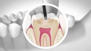 ¿Qué son las Caries Dentales  Empaste dental para dientes y muelas con caries [upl. by Atibat]