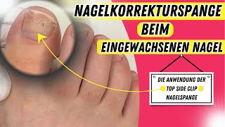 NAGELSPANGE Top Side Clip für EINGEWACHSENE NÄGEL und ROLLNÄGEL  Podologie  Nagelkorrekturspange [upl. by Aseeram]