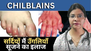 CHILBLAINS I सर्दियों मैं उँगलियाँ सूजने का इलाज – DR ANAND [upl. by Inavoy]