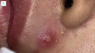 Big Cystic Acne Blackheads Extraction Blackheads amp Milia Whiteheads Removal Pimple Popping [upl. by Asiek]