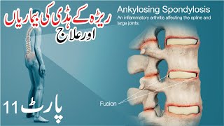 Ankylosing spondylitis Treatment [upl. by Aim]