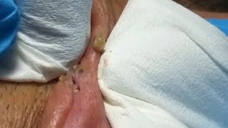 Old Blackhead Extraction Compilation with some of the techniques used [upl. by Zachariah]