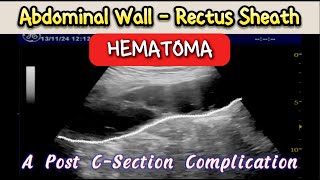 Abdominal Wall  Rectus Sheath  Hematoma  Post CSection Complication [upl. by Jemie]