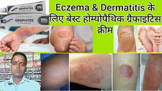 SBL Graphites Ointment Eczema Dermatitis की बेस्ट होम्योपैथिक मेडिसिन [upl. by Chelsey]