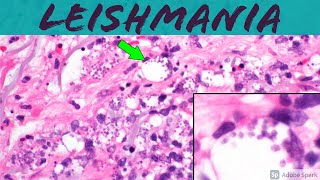 Leishmaniasis Leishmania Infection 5Minute Pathology Pearls ‪Dermatology Dermatopathology [upl. by Jacobba]