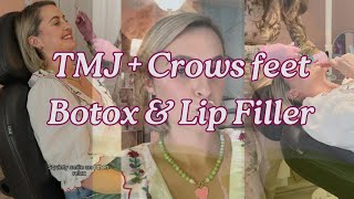 TMJ  Crows Feet Botox and Lip Filler [upl. by Morgan]