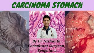 CARCINOMA STOMACH  THE WHITE ARMY WEBINAR [upl. by Eeldarb349]