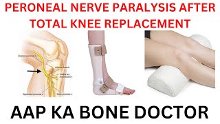 PERONEAL NERVE PALSY AFTER KNEE REPLACEMENT  EPISODE 27 [upl. by Tedman171]