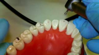 Occlusal Equilibration [upl. by Macmullin947]