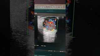 Breast Cancer on Ultrasound Breast medical cancer ultrasound doppler shorts viral health [upl. by Althea]