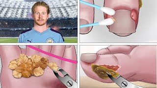 ASMR Help Kevin De Bruyne take care of his toenails and remove ingrown toenails [upl. by Atrahc]