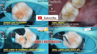 class I cavity with palfique universal flow super low estelite flow quick tokuyama konservasi gigi [upl. by Anilah]